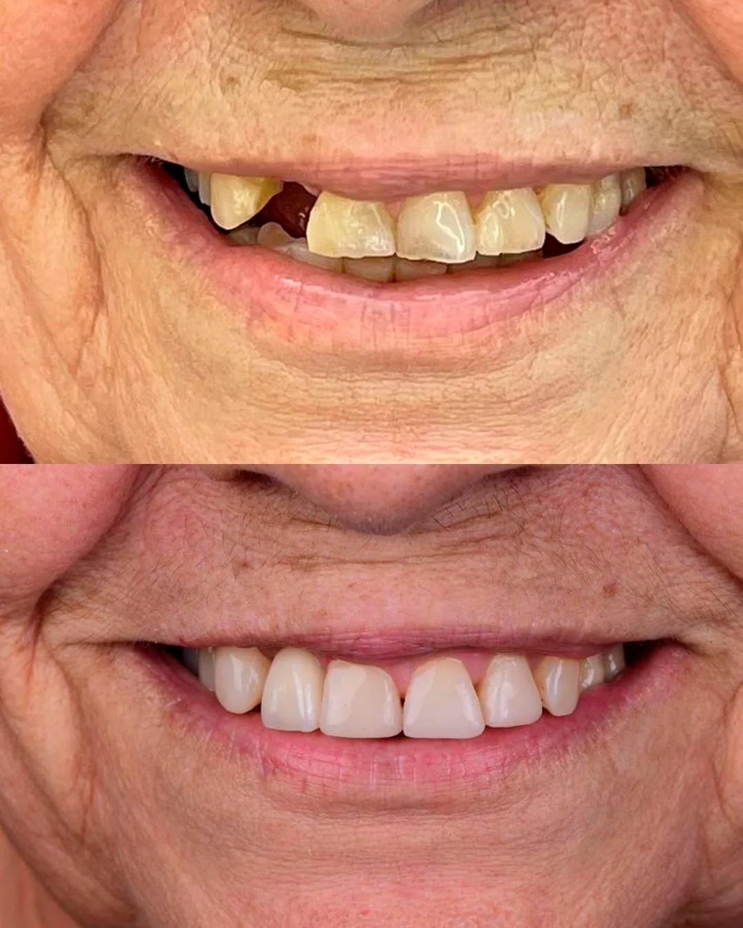 Antes e depois de implante dentário com a Dra. Beatriz Torres de Melo, Fortaleza