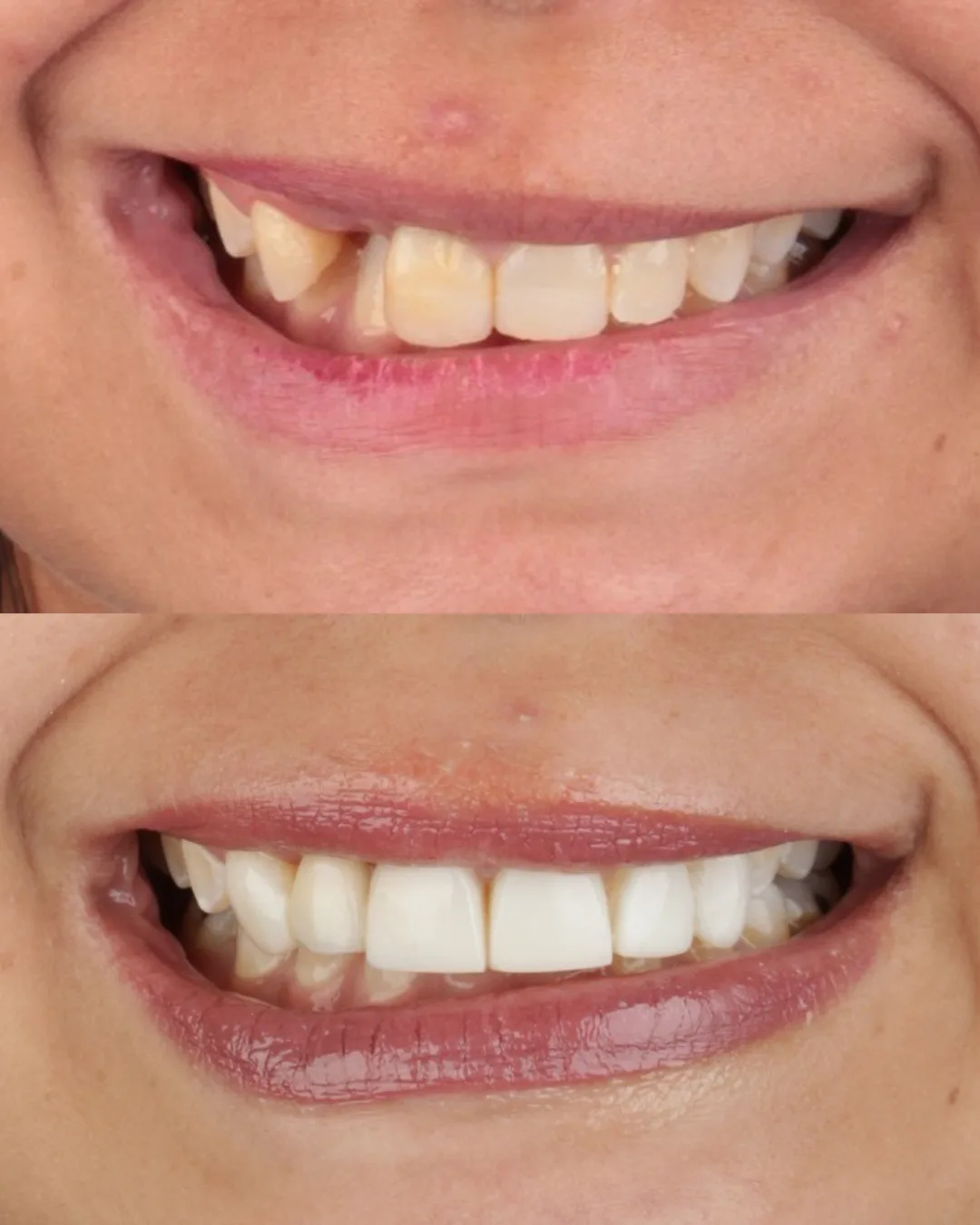 Antes e depois de reabilitação oral com a Dra. Beatriz Torres de Melo, Fortaleza