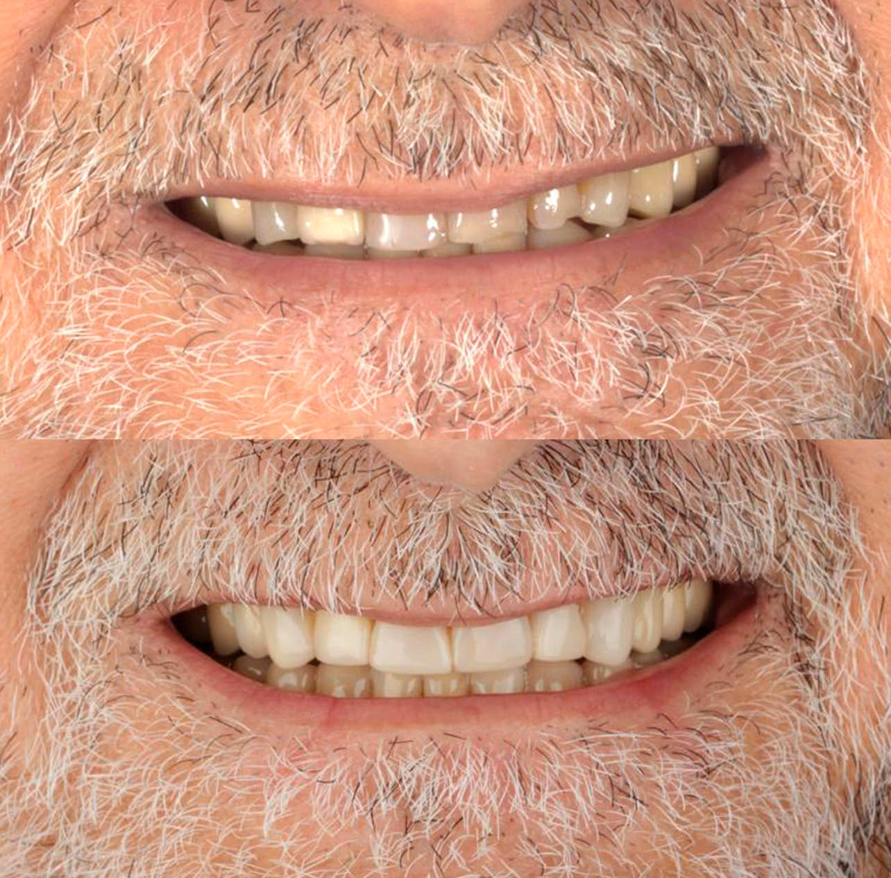 Coroas em porcelana